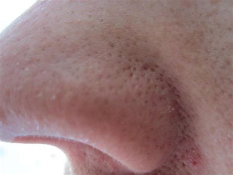 large pores on either side of nose
